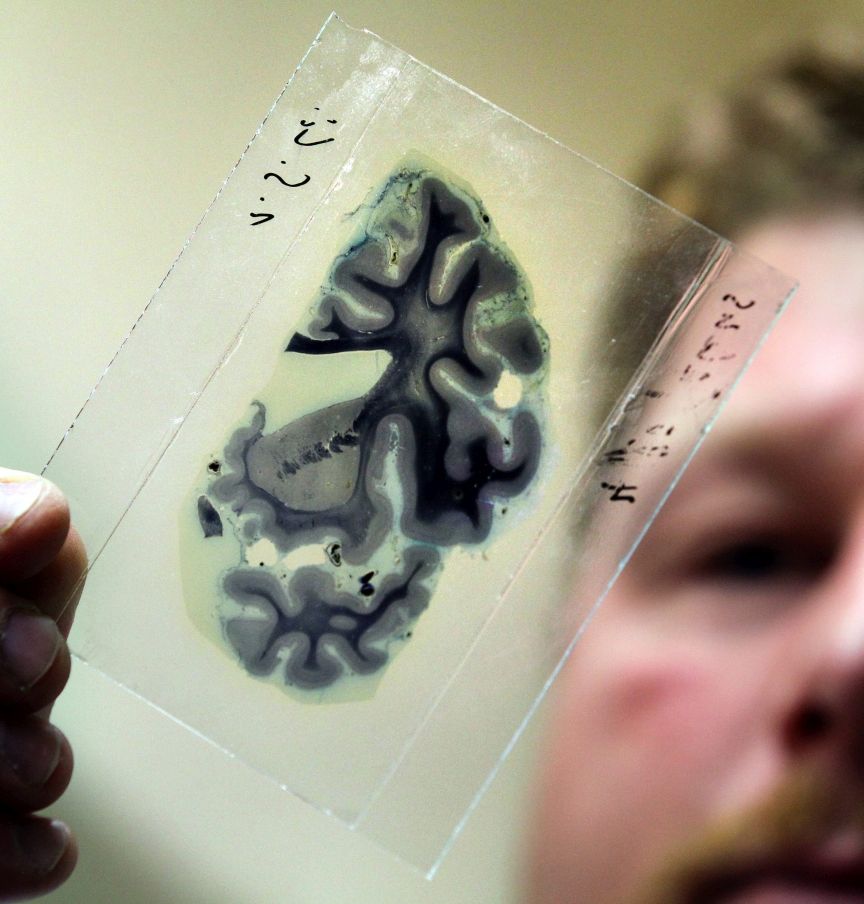 Research for new treatment of Alzheimer disease