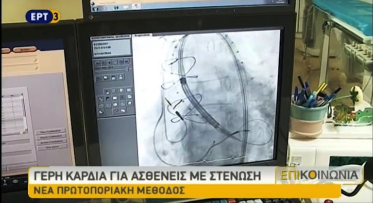 Πρωτοποριακή επέμβαση καρδιάς στο νοσοκομείο Παπαγεωργίου (video)