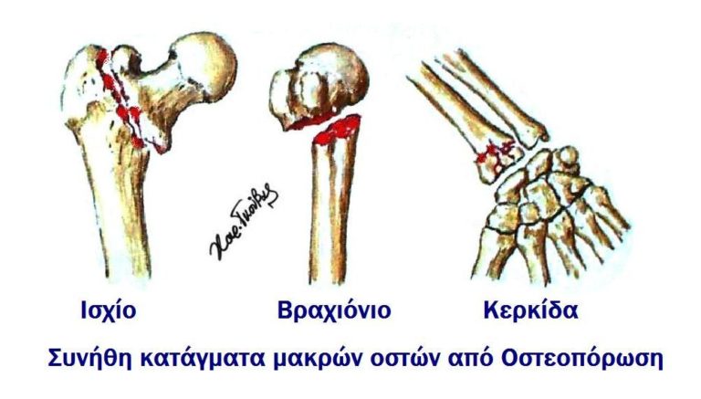 Ομιλία για την οστεοπόρωση στα Α΄και Δ΄ ΚΑΠΗ