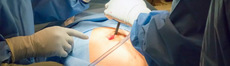 Ένα 16χρονο κορίτσι έκρυβε ένα μίνι-εγκέφαλο μέσα στην ωoθήκη της!