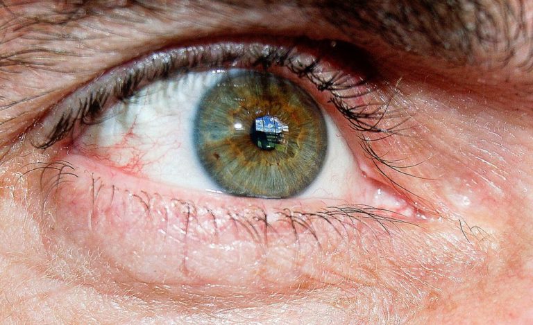 Εμφύτευμα βλαστοκυττάρων βελτίωσε την όραση σε ασθενείς με ξηρά εκφύλιση της ωχράς κηλίδας