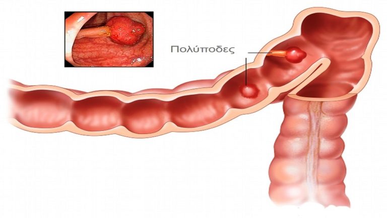 Διεθνές συνέδριο για τον καρκίνο του παχέος εντέρου