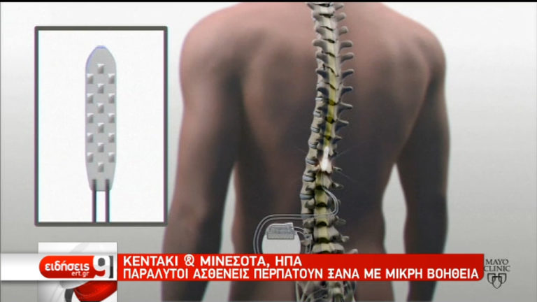 Ηλεκτρονικό εμφύτευμα χαρίζει κίνηση σε παράλυτους ασθενείς (video)