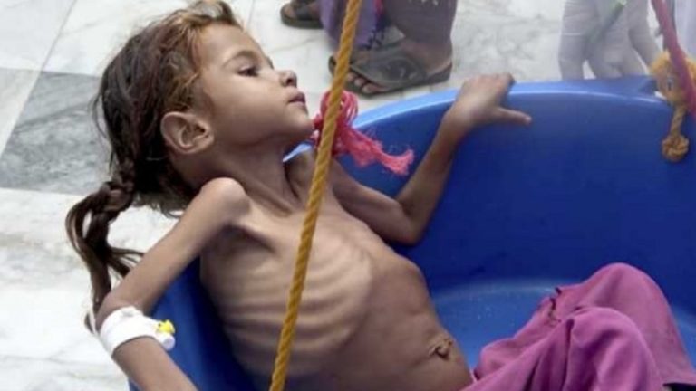 Πέθαναν από πείνα 85.000 παιδιά πριν γίνουν 5 ετών στην Υεμένη (video)