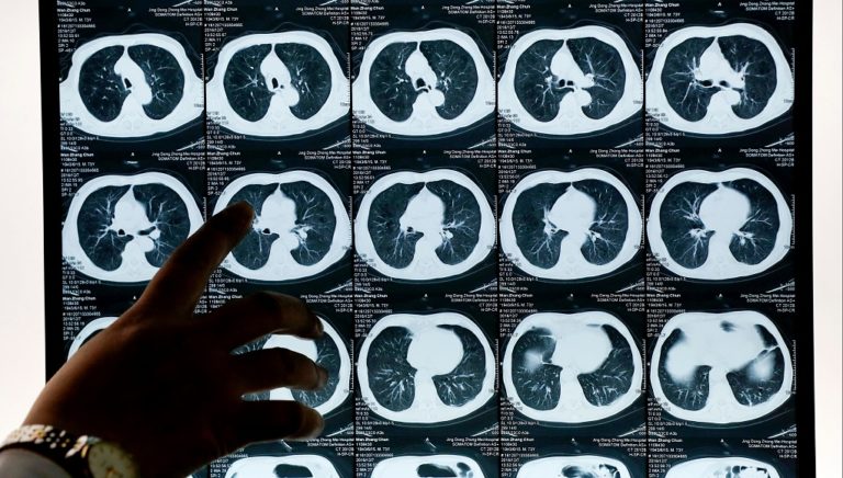 Γαλλία: Πέθανε από καρκίνο αφότου της μεταμόσχευσαν πνεύμονες καπνίστριας
