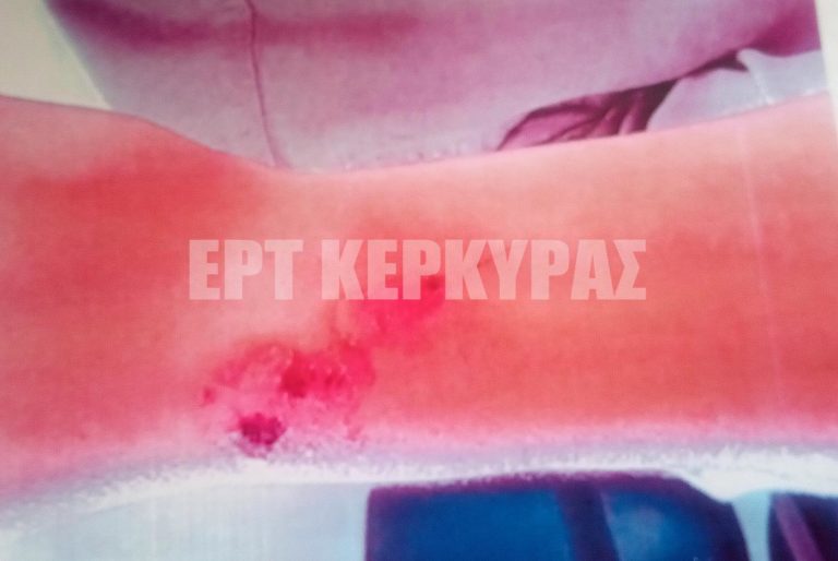 Κέρκυρα: Σπουδαστής καταγγέλλει «μεσαιωνικά» βασανιστήρια σε κουζίνα εστιατορίου!