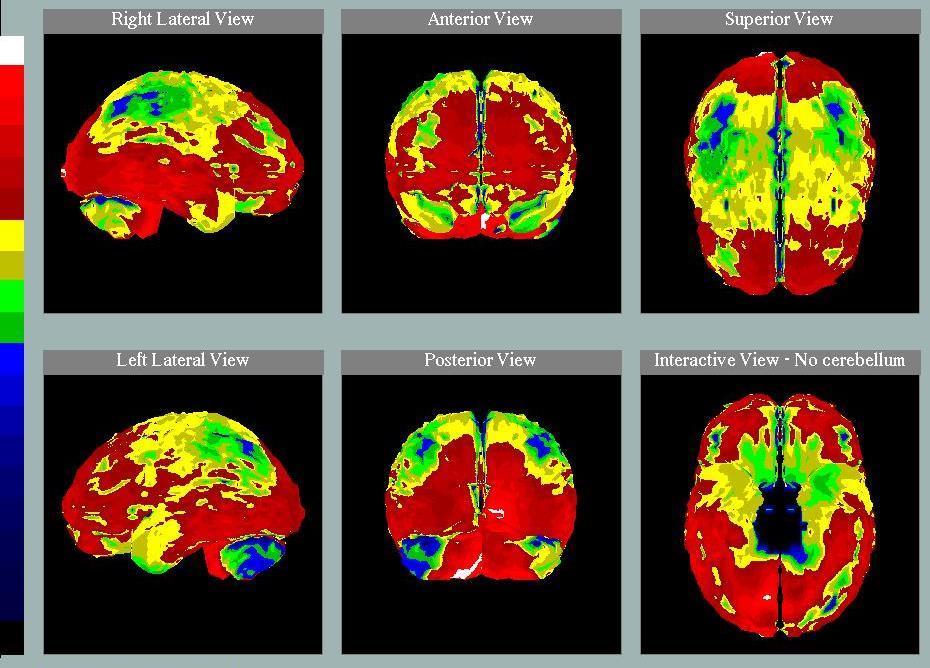 Έναρξη εξέτασης σπινθηρογραφήματος μελέτης βασικών γαγγλίων εγκεφάλου στο Νοσοκομείο Χανίων