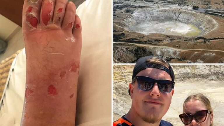 Βρετανός τουρίστας υπέστη εγκαύματα στο ηφαίστειο της Νισύρου-«Μπήκε στο χώρο με δική του ευθύνη» απαντά ο Δήμος