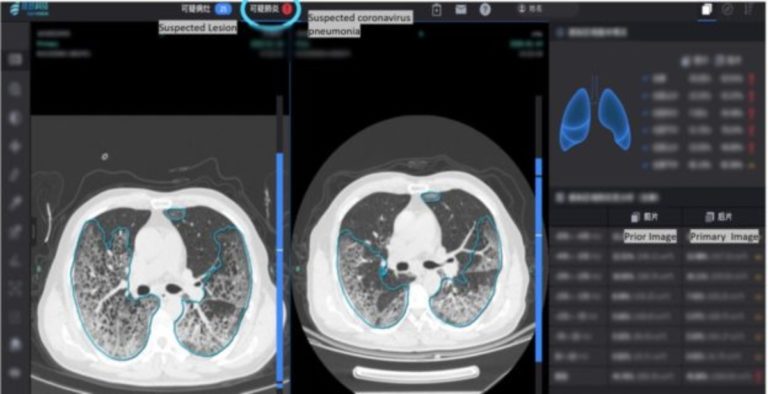 Γιατροί στην Κίνα χρησιμοποιούν την τεχνητή νοημοσύνη για την ταχεία ανίχνευση κορονοϊού