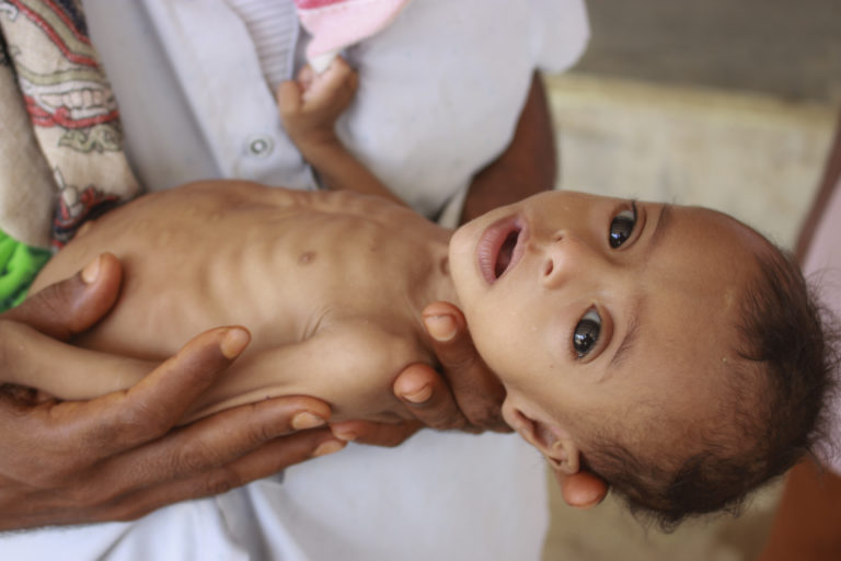 Υεμένη: Σε πρωτόγνωρα επίπεδα ο υποσιτισμός των παιδιών, προειδοποιεί ο ΟΗΕ – H μεγαλύτερη ανθρωπιστική κρίση παγκοσμίως