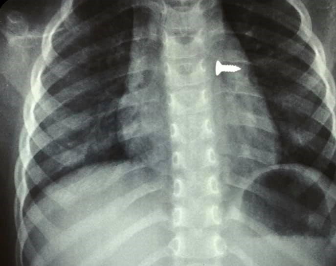 Ηράκλειο: Αφαίρεση βίδας από τον αριστερό πνεύμονα τρίχρονης (εικόνες)