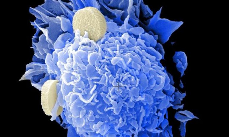 Αυξημένος ο κίνδυνος δεύτερου καρκίνου για όσους επιβίωσαν από τον πρώτο, σύμφωνα με αμερικανική μελέτη