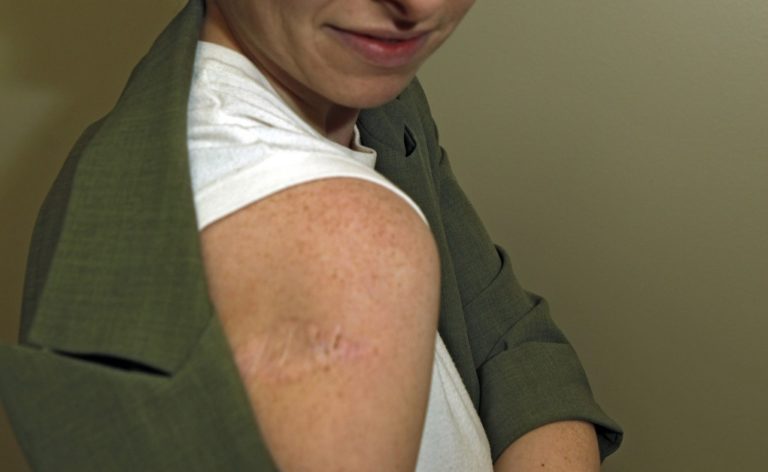Αντικαρκινικό εμβόλιο προστατεύει για τέσσερα χρόνια από υποτροπή του μελανώματος στο δέρμα