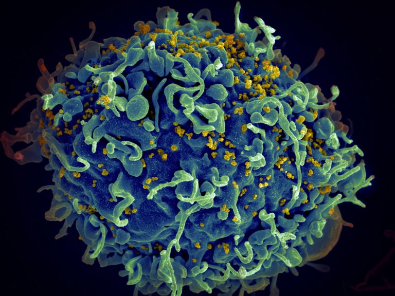 ΗΠΑ: Γυναίκα θεραπεύτηκε από τον ιό HIV αφού υποβλήθηκε σε μεταμόσχευση μυελού των οστών