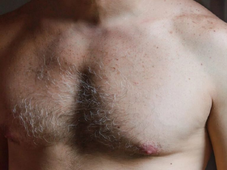 Νέα μελέτη δείχνει σημαντική συσχέτιση υπογονιμότητας και κινδύνου καρκίνου του μαστού στους άνδρες