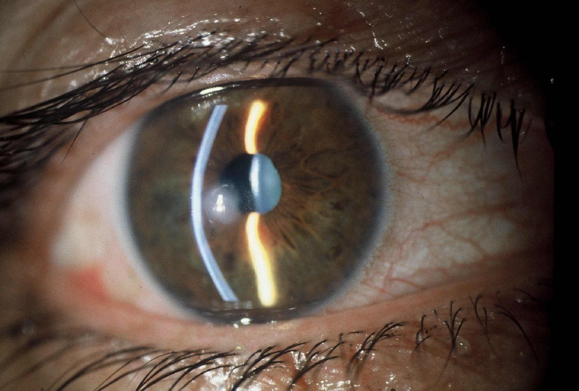 Κερατοειδής χιτώνας από κολλαγόνο χοίρου αποκατέστησε την όραση σε τυφλούς ανθρώπους