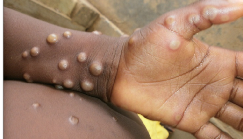Monkey pox