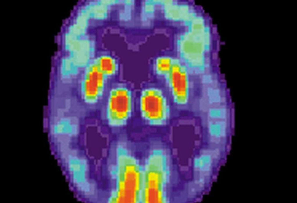 Ερευνητές αναζητούν τα αίτια της νόσου Αλτσχάιμερ με τη βοήθεια της τεχνητής νοημοσύνης