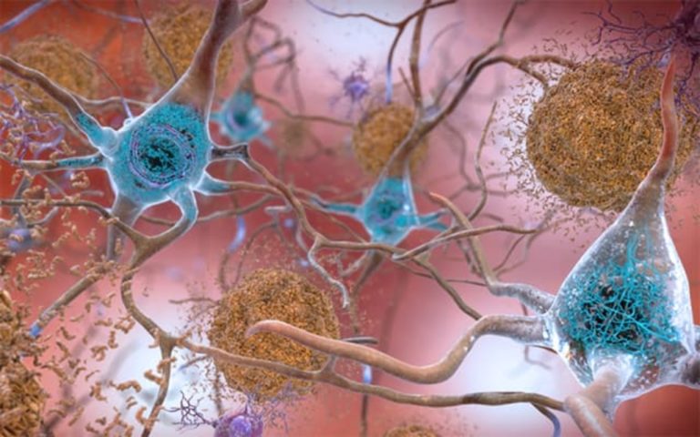 Επιστήμονες ανέπτυξαν εξέταση αίματος για τη διάγνωση του Αλτσχάιμερ
