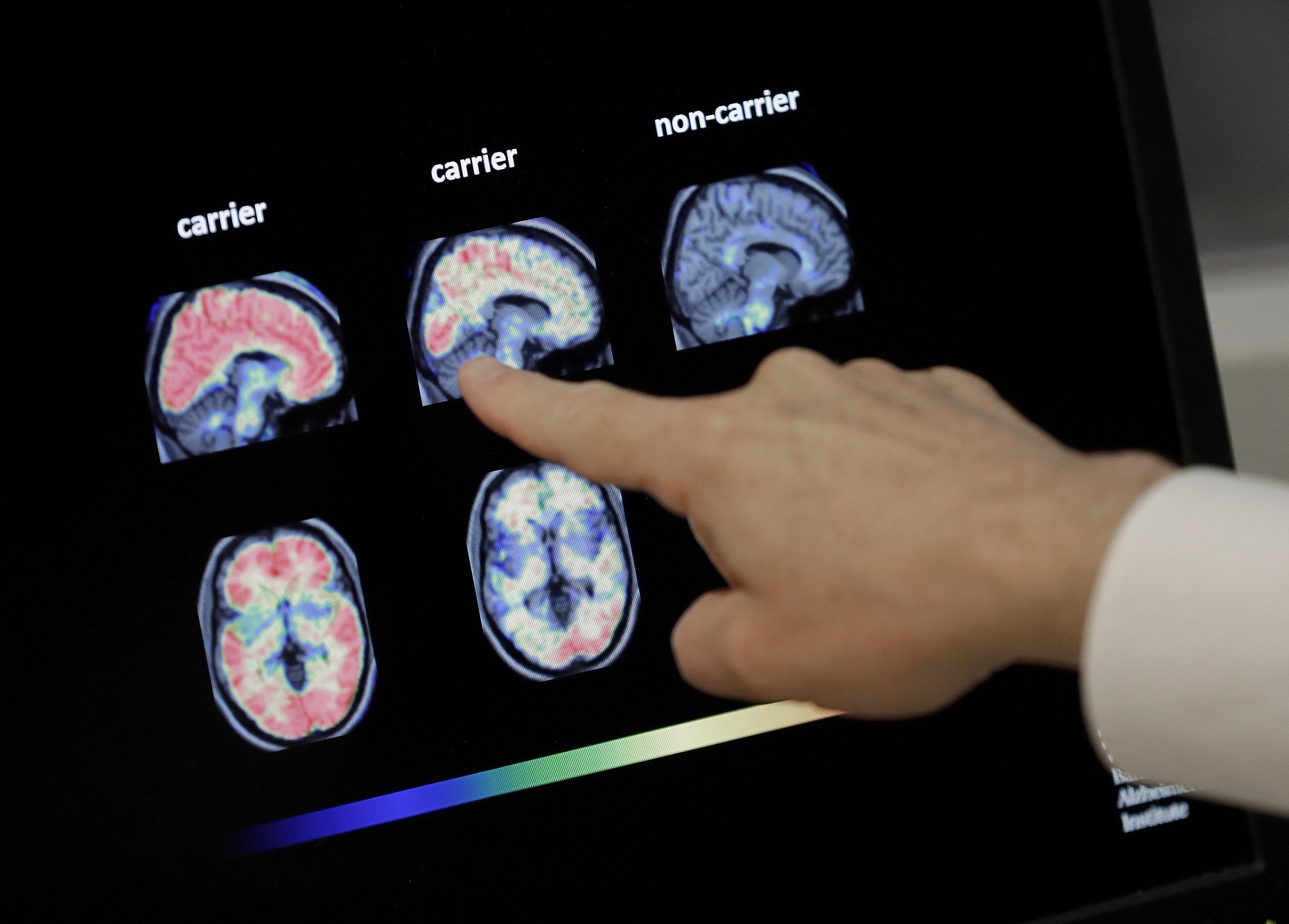 Έρευνα συνδέει τη γήρανση του εγκεφάλου με τη νόσο SARS-CoV-2