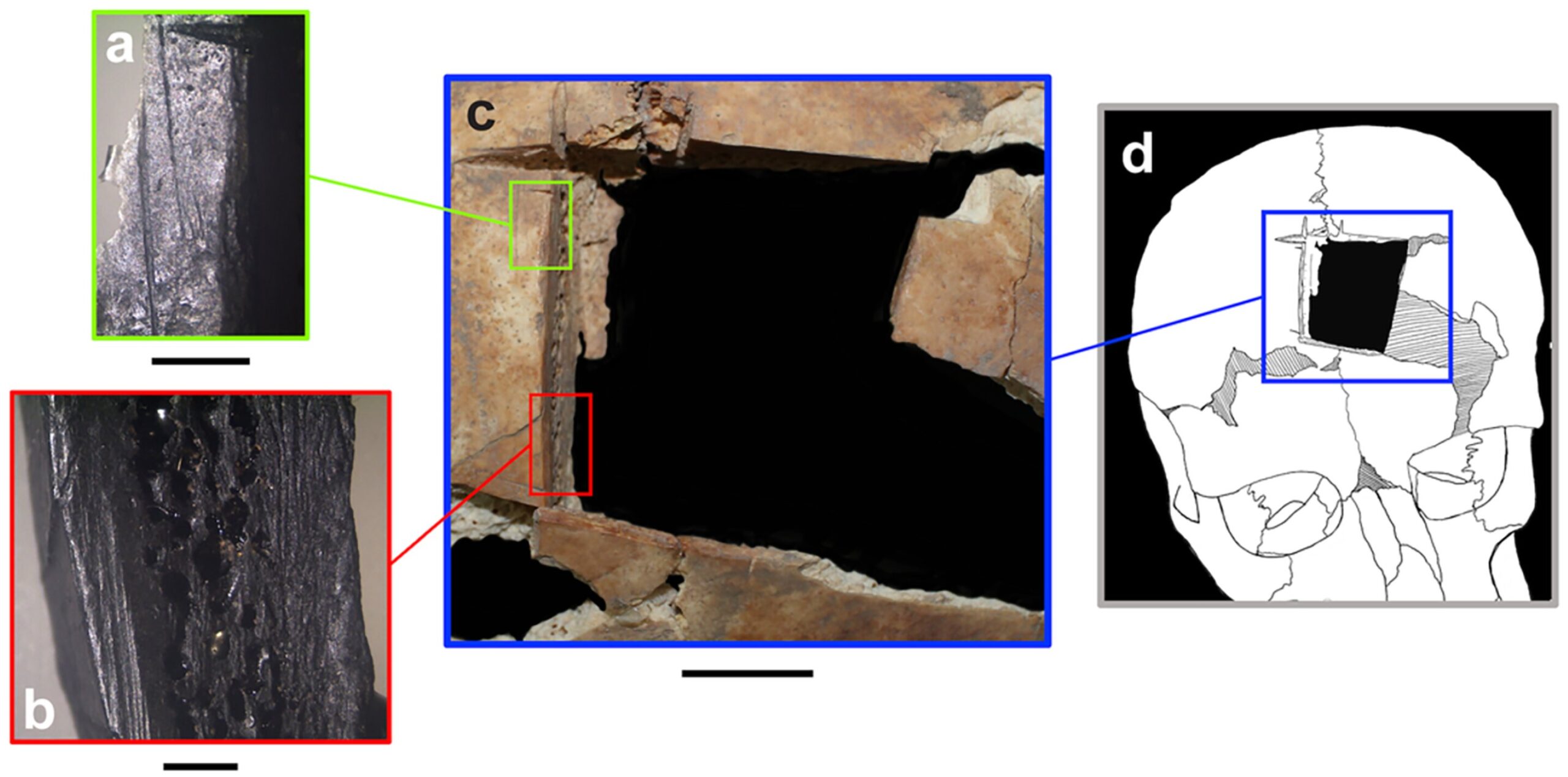 Τρυπανισμός+κρανίου+Πηγή+Kalisher+et+al.,+2023,+PLOS+ONE,+CC-BY+4.0