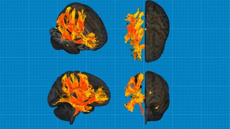 Ερευνητές εντόπισαν περιοχές του εγκεφάλου που επηρεάζονται από την υψηλή πίεση και σχετίζονται με την άνοια