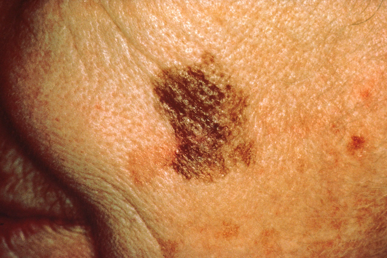 Moderna skin cancer vaccine