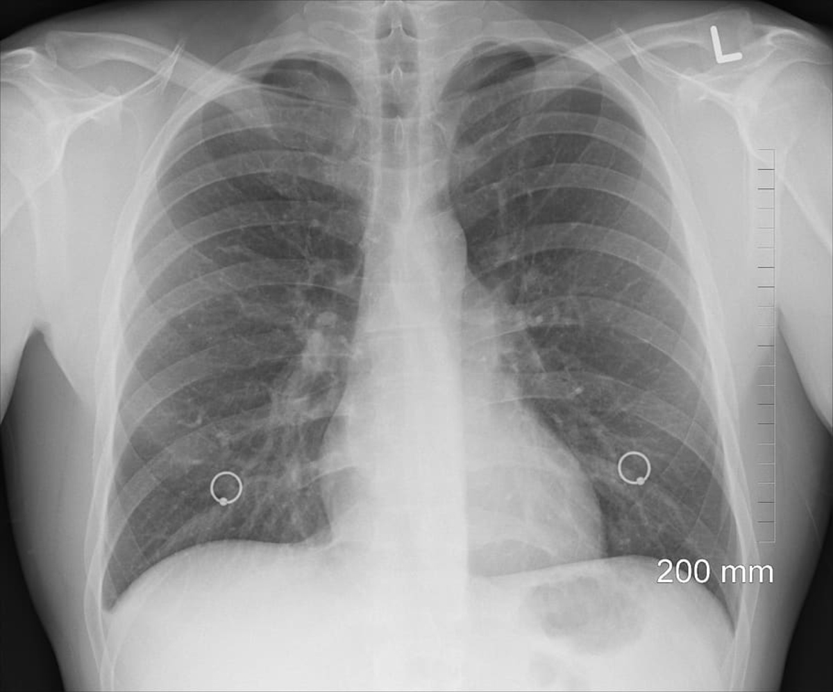 diagnosis-xray-chest-lungs-ribs-body (1)