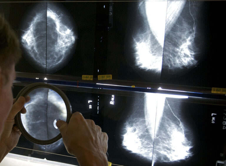 Φάρμακο για τον καρκίνο του μαστού δείχνει να μειώνει τον κίνδυνο υποτροπής