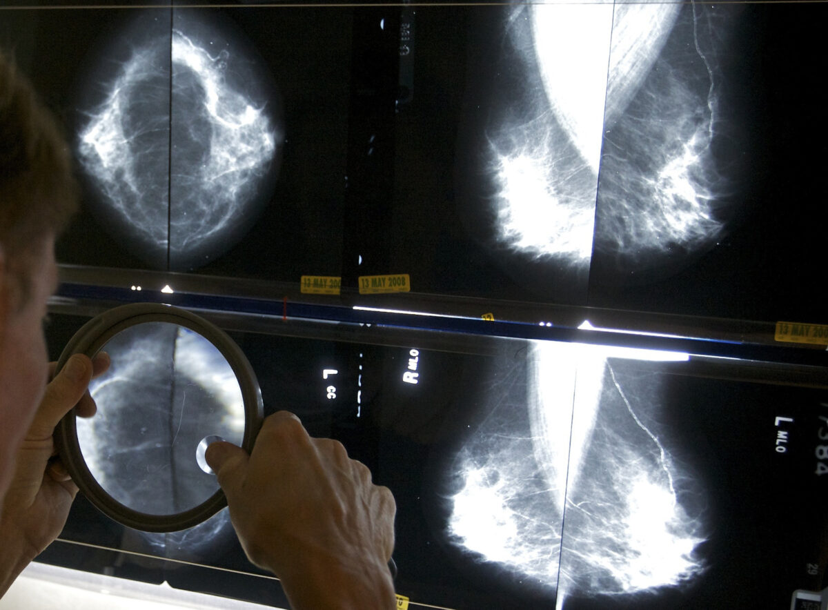 Φάρμακο για τον καρκίνο του μαστού δείχνει να μειώνει τον κίνδυνο υποτροπής