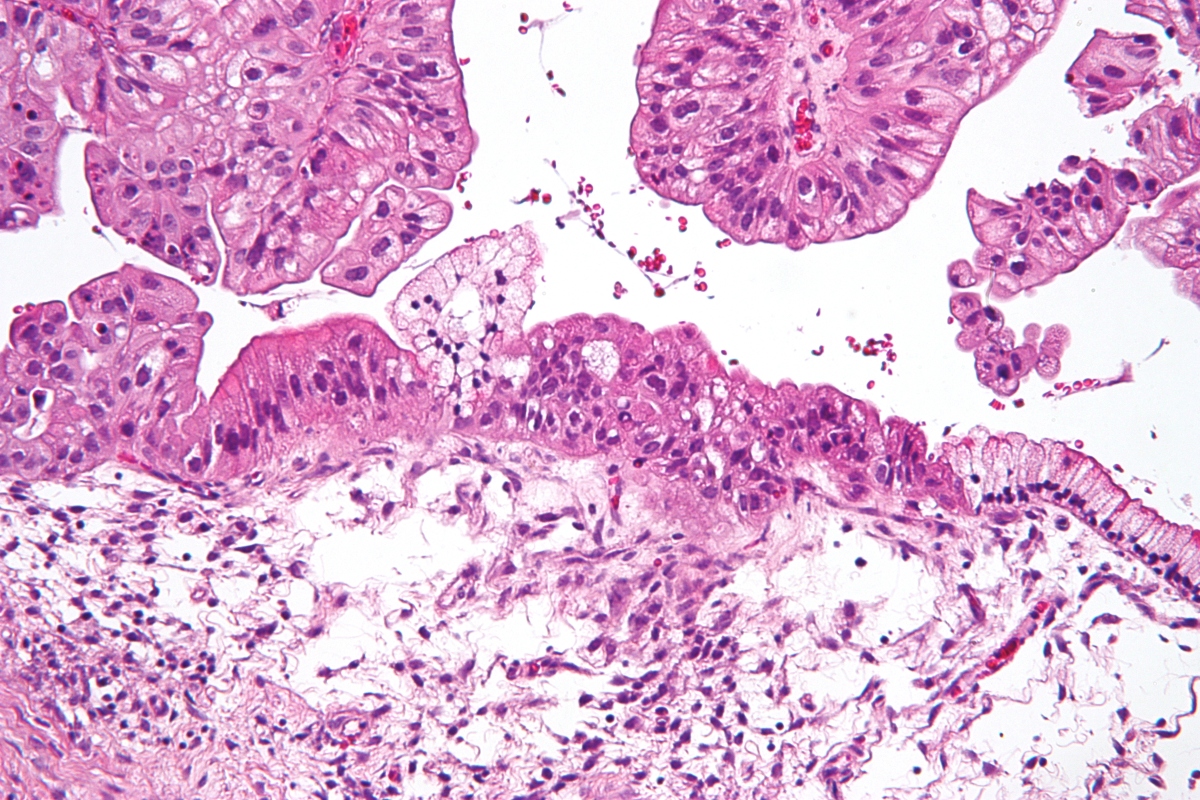 Mucinous_lmp_ovarian_tumour_intermed_mag (1)