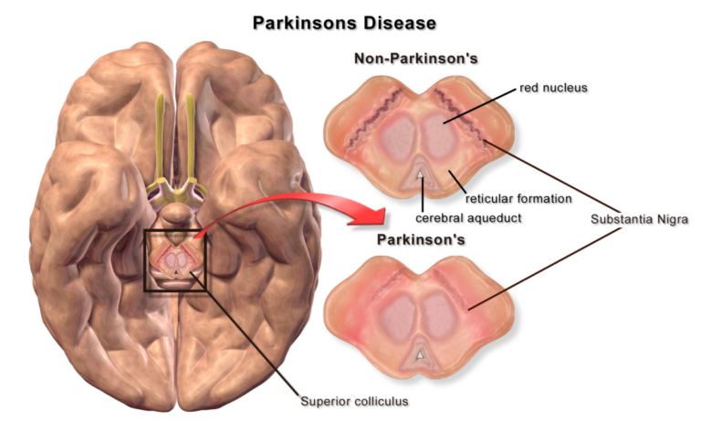 Πάρκινσον: Πρωτοποριακό χάπι μπορεί να αντιμετωπίσει τα συμπτώματα χωρίς παρενέργειες