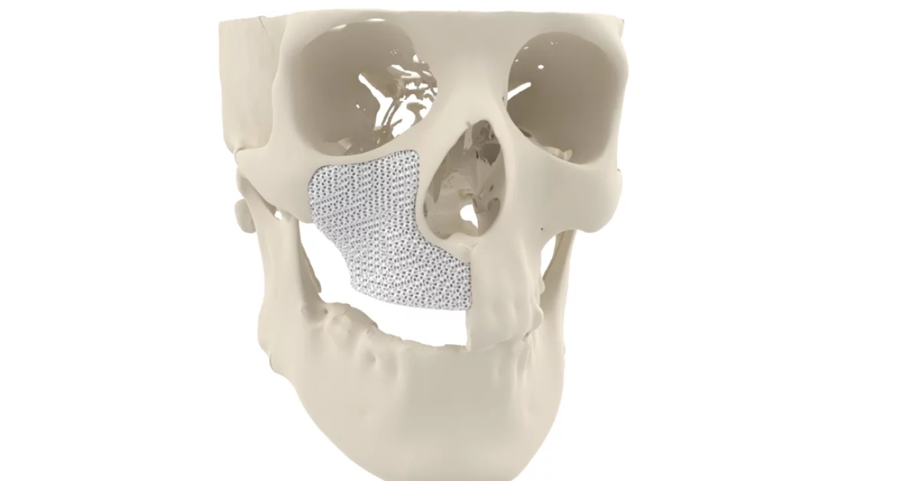 maxillary_reconstruction-f141376e