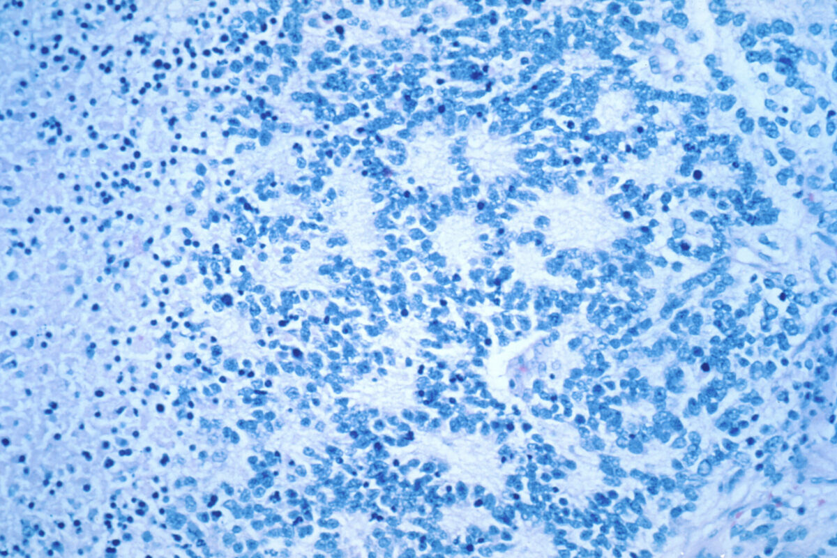 This December 1993 microscope photo provided by the National Cancer Institute shows a typical neuroblastoma with rosette formation. In a study published Wednesday, April 5, 2023, in the New England Journal of Medicine, a novel treatment, CAR-T cell therapy, using supercharged immune cells, appears to work against tumors in children with the rare kind of cancer.