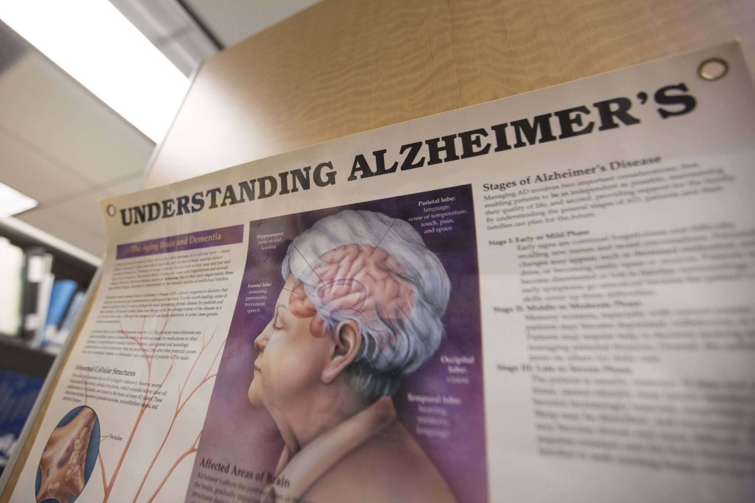 Κίνα: Σχεδόν 10 εκατομμύρια άνθρωποι πάσχουν από Αλτσχάιμερ