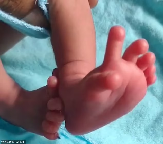 Ινδία: Μωρό γεννήθηκε με 14 δάχτυλα στα χέρια και 12 δάχτυλα στα πόδια