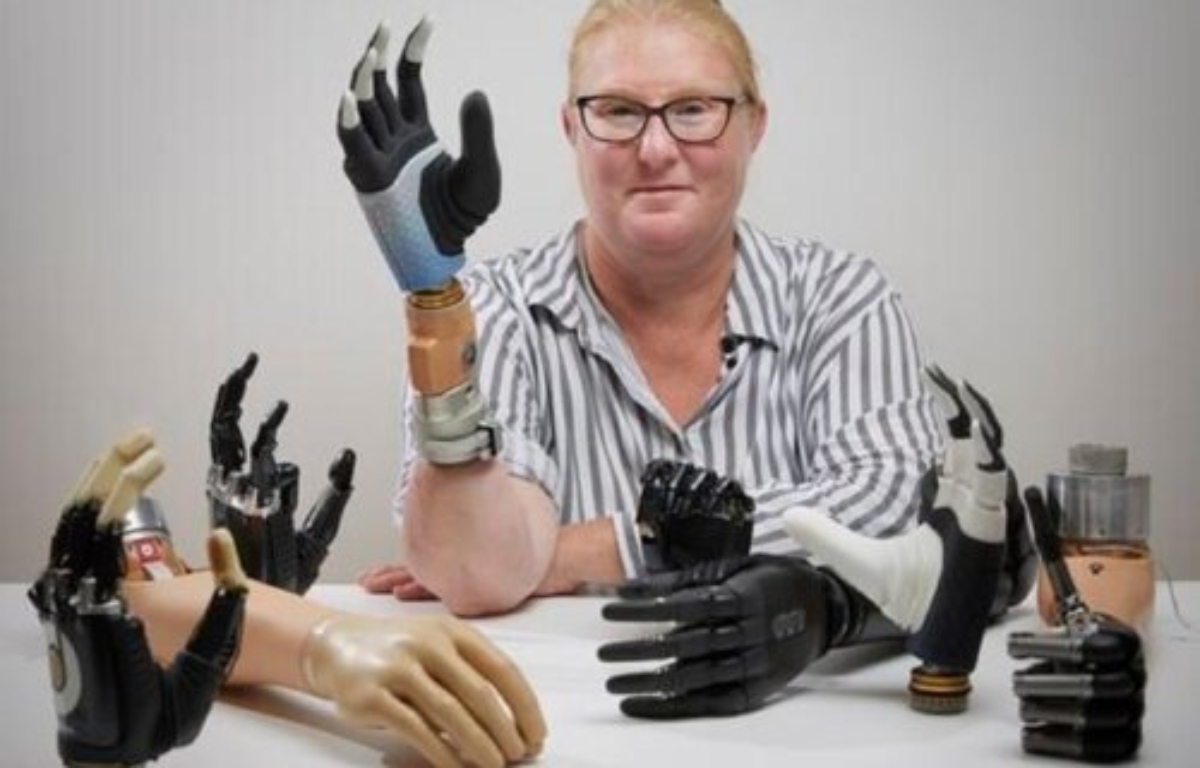 Σουηδία: Η πρώτη «βιονική» γυναίκα στον κόσμο διαθέτει ρομποτικό χέρι που «ενσωματώνεται» στον σκελετό