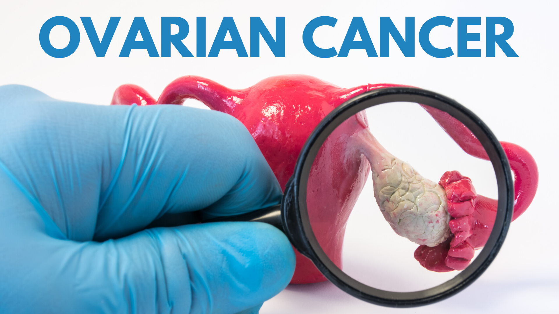 OVARIAN-CANCER