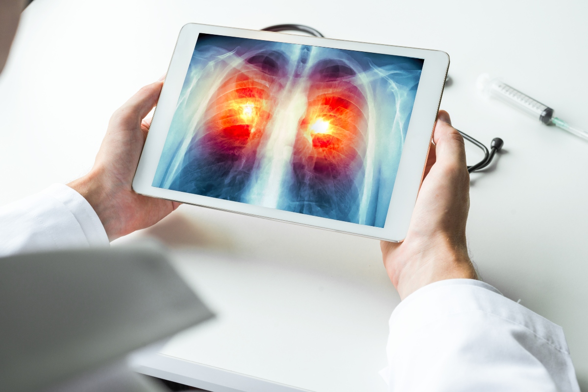 Lung+Cancer+Screening
