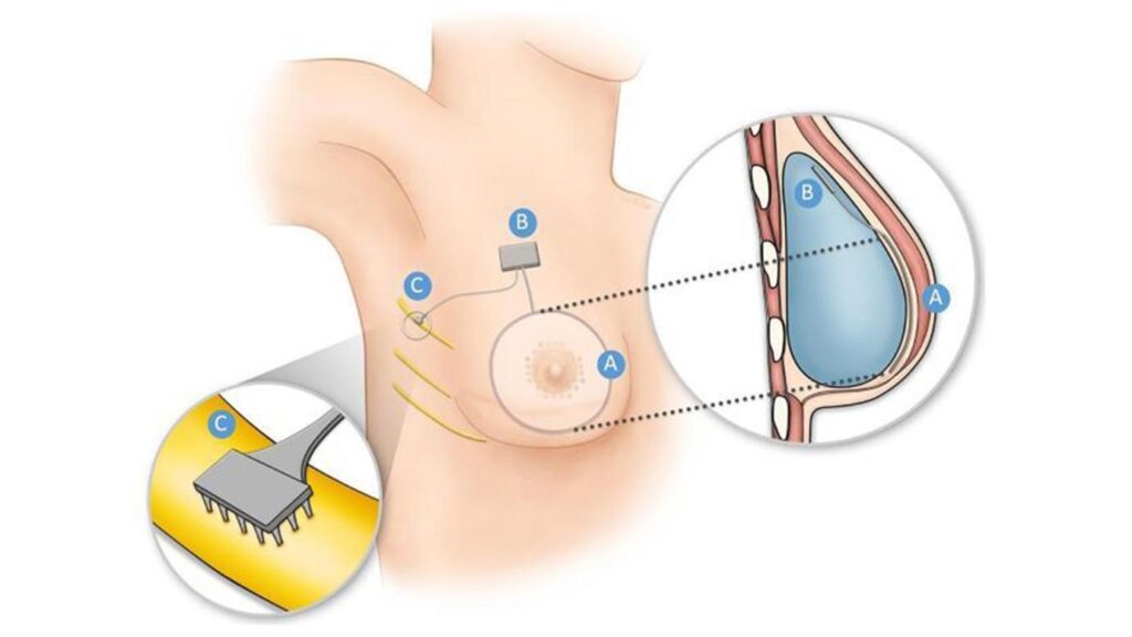 Επιστήμονες αναπτύσσουν «βιονικό» μαστό που αποκαθιστά την αίσθηση του στήθους μετά από μαστεκτομή