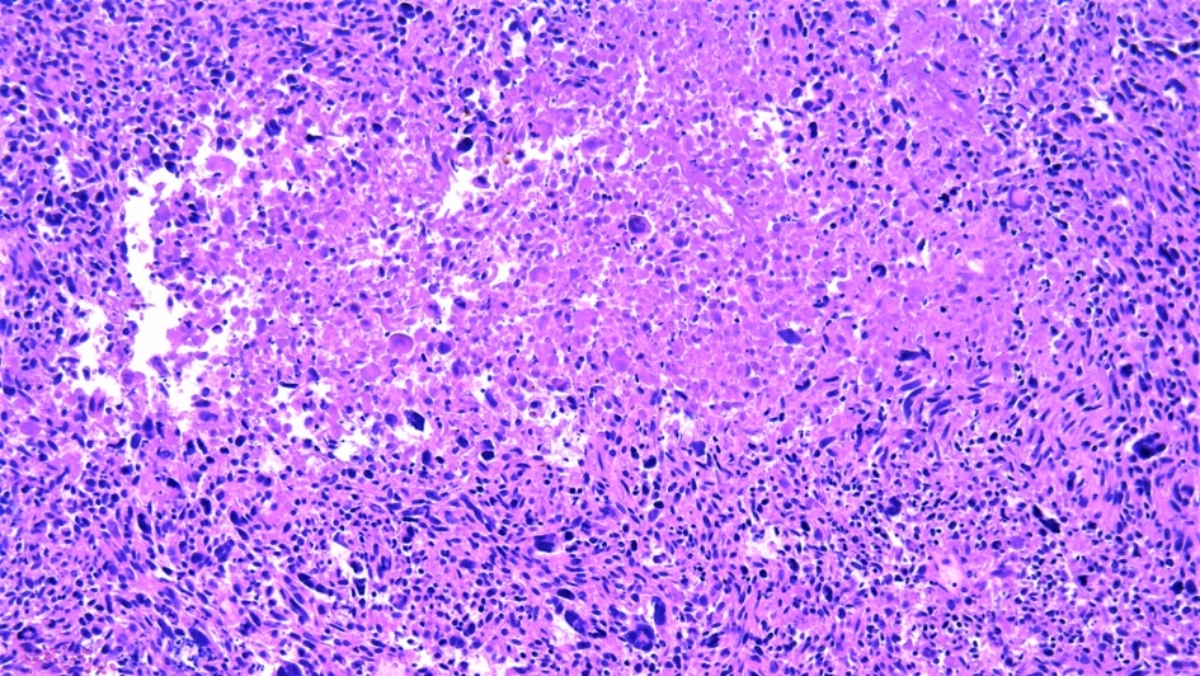 leiomyosarcoma-wikimedia-945x532 (1)