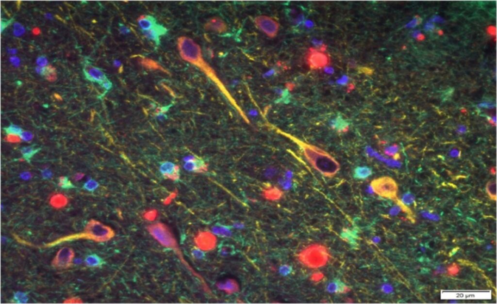 Μελέτη συνδέει το βακτήριο της νόσου των ουλών με το Αλτσχάιμερ