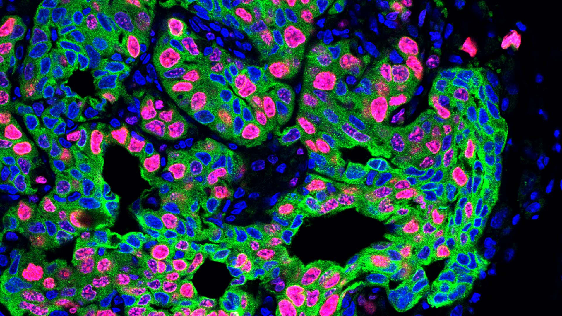 Lung_Cancer_Metastasis