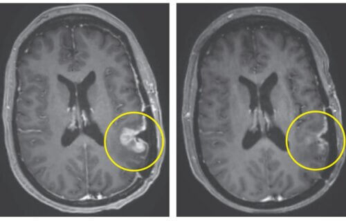 Καρκίνος του εγκεφάλου: Πρωτοποριακή θεραπεία εξάλειψε τον όγκο σε μόλις 5 ημέρες