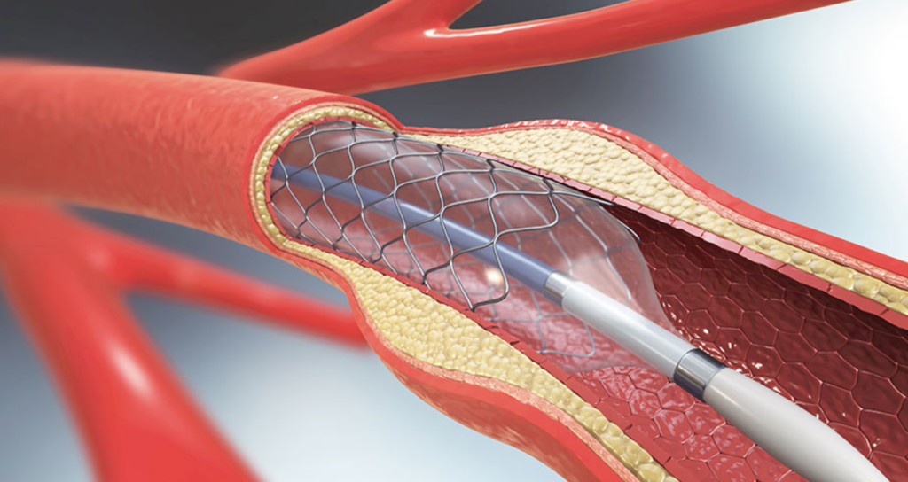Χρήση προληπτικού στεντ για την πρόβλεψη εμφραγμάτων και αιφνίδιων θανάτων