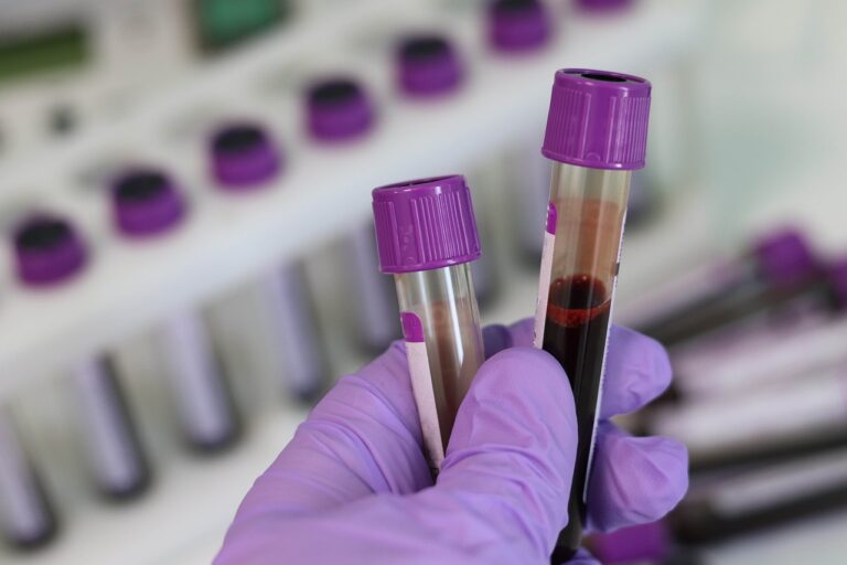 Βρετανία: Πρόβλεψη του καρκίνου επτά χρόνια νωρίτερα δείχνει έρευνα που χρησιμοποίησε τις πρωτεΐνες του αίματος