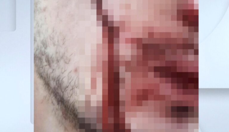 Θεσσαλονίκη: Έρευνα της Αστυνομίας για επιθέσεις με μαχαίρι σε περαστικούς στις Σαράντα Εκκλησιές