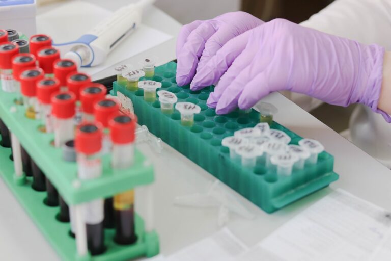 Νέο τεστ ούρων ανιχνεύει το 92% των επιθετικών καρκίνων του προστάτη