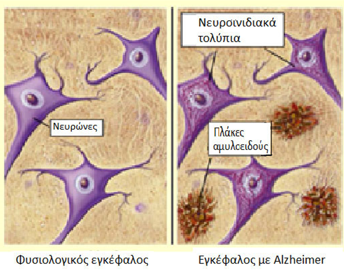 ΑΠΘ: Καινοτόμα αιματολογική εξέταση για την έγκαιρη διάγνωση της νόσου Alzheimer
