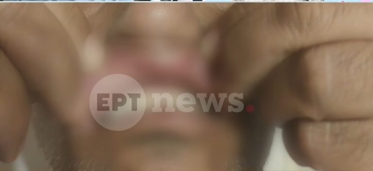 Απρόκλητη επίθεση επιβάτη σε οδηγό λεωφορείου του ΟΑΣΑ: Του έσπασε το ζυγωματικό και τον τραυμάτισε σε μάτι και ούλα
